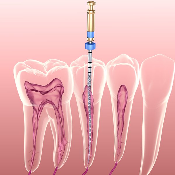 Endodontie / Wurzelbehandlung - AdobeStock_277311336