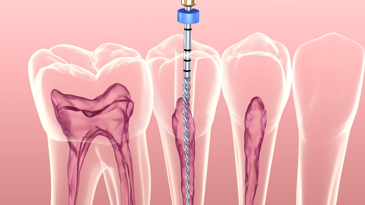 Endodontie / Wurzelbehandlung - AdobeStock_277311336