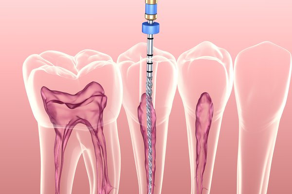 Endodontie / Wurzelbehandlung - AdobeStock_277311336